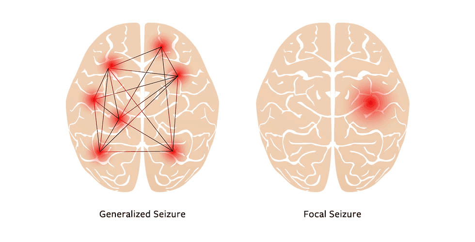 Understanding Seizures